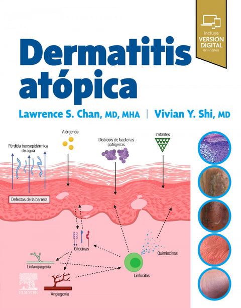  Dermatitis atopica 