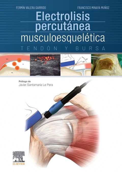  Electrolisis percutánea musculoesquelética. Tendón y bursa 