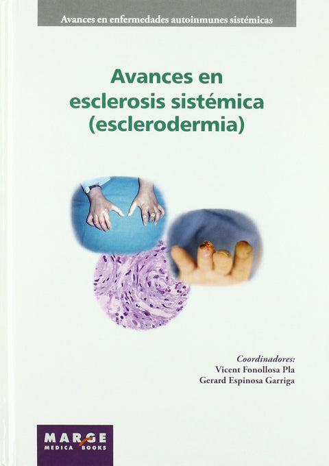  Avances en esclerosis sistémica (esclerodermia) 