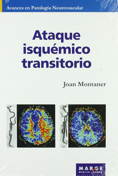  Ataque isquémico transitorio 