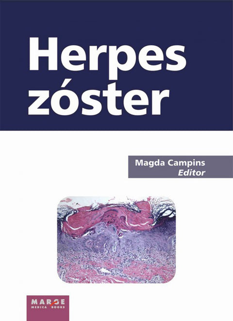 Herspes Zoster 